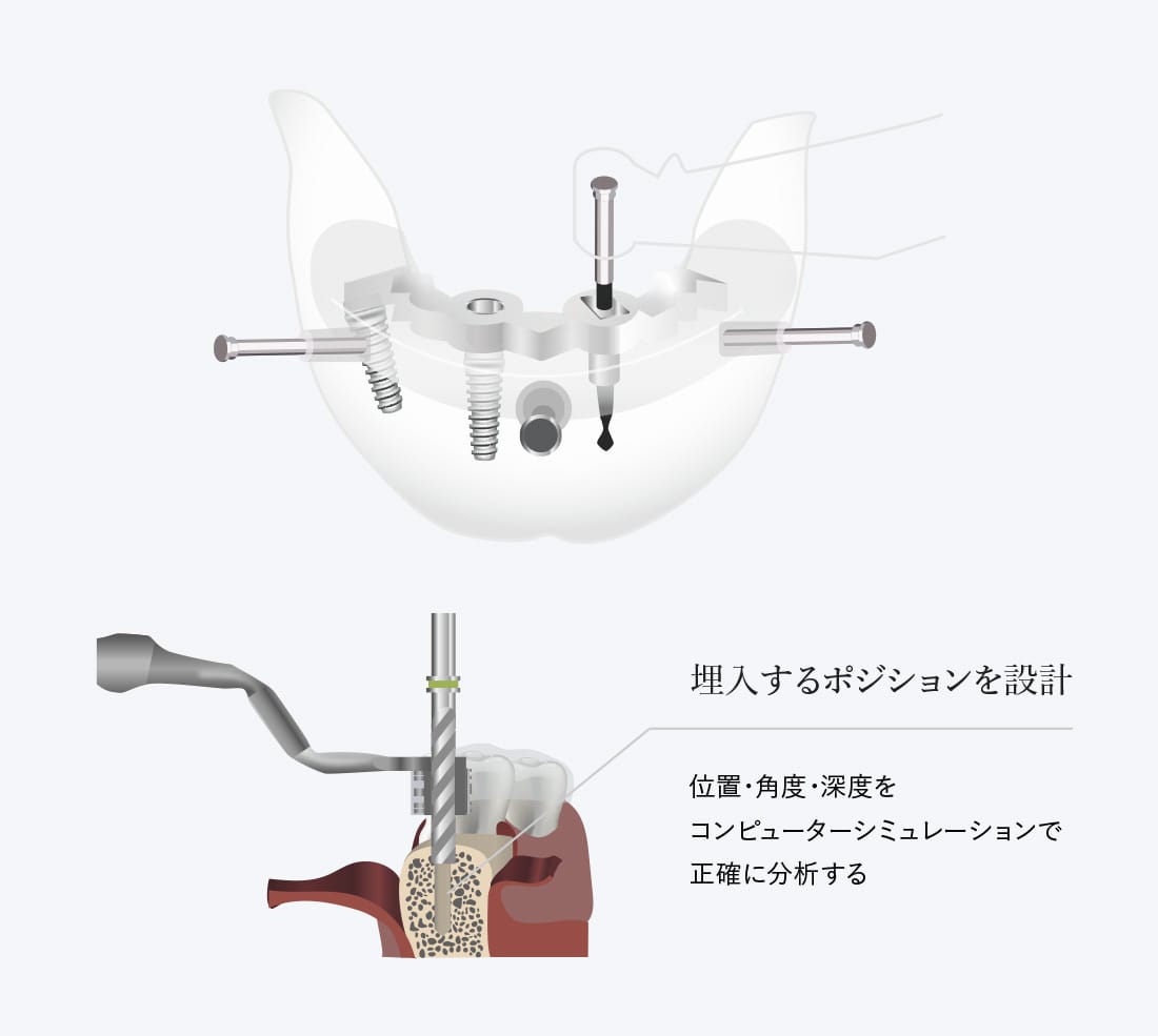 機能的な咬み合わせを実現する咬合面のクオリティ