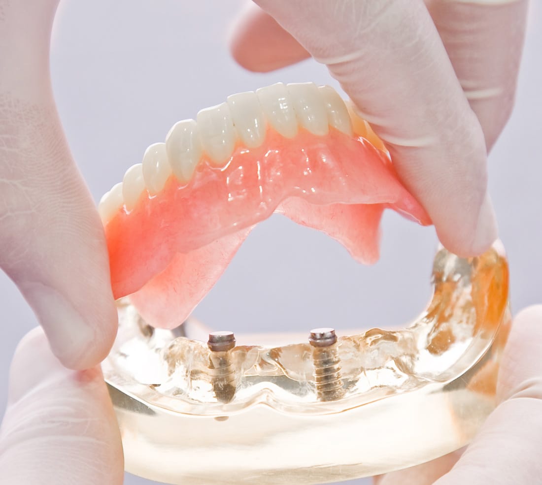 負担を最大限に抑えた義歯ジャストフィットの咬合性