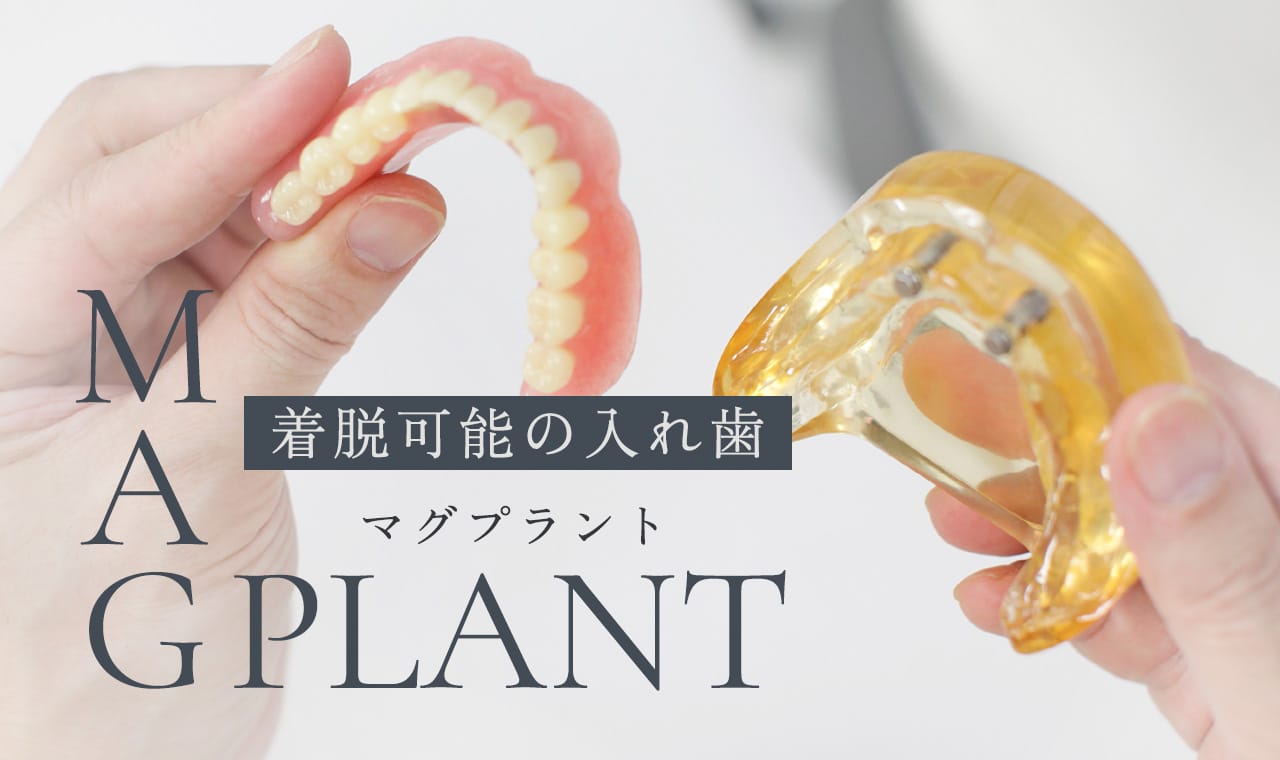 着脱可能の入れ歯マグプラント